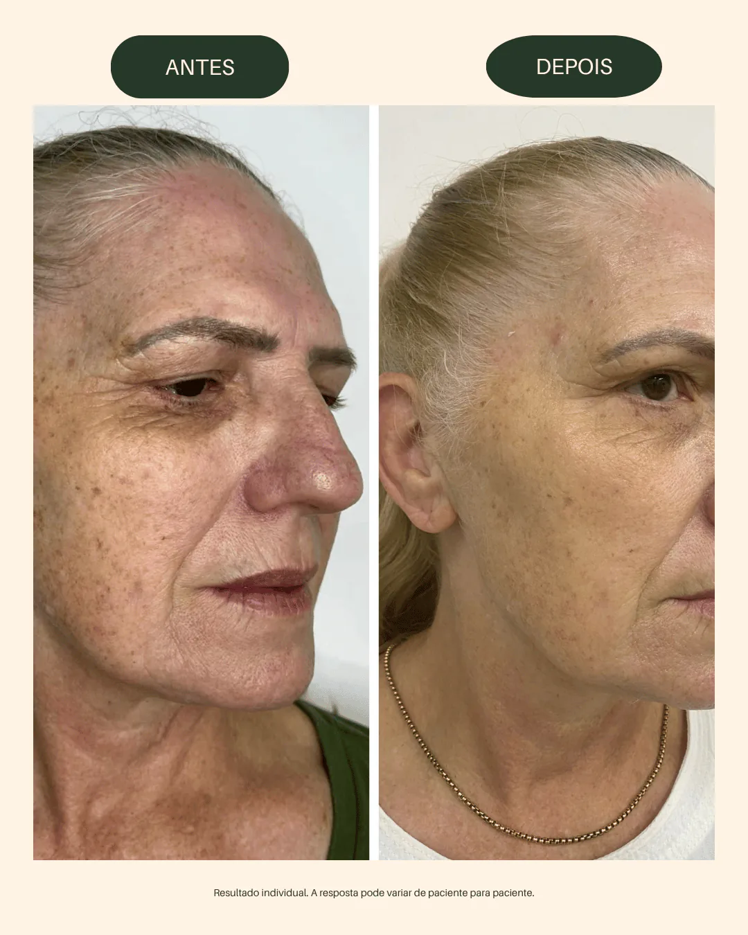 Resultado antes e depois do Laser CO₂ na Baumi Clínica em Cascavel.