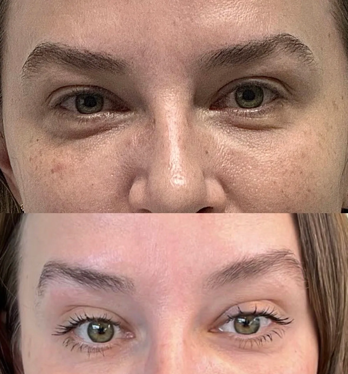 Resultado antes e depois do ultraformer na Baumi Clínica em Cascavel.